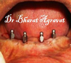 ball and socket implant denture before ahmedabad, india