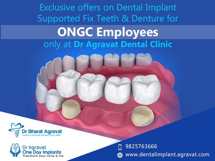 Offer ONGC Employees Fix Teeth bridge best Dental Implants clinic ongc panel dental surgeon in ahmedabad gujarat india G
