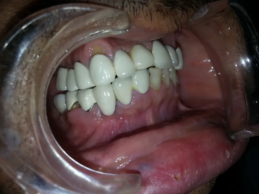 Permanent fixed teeth after basal implants