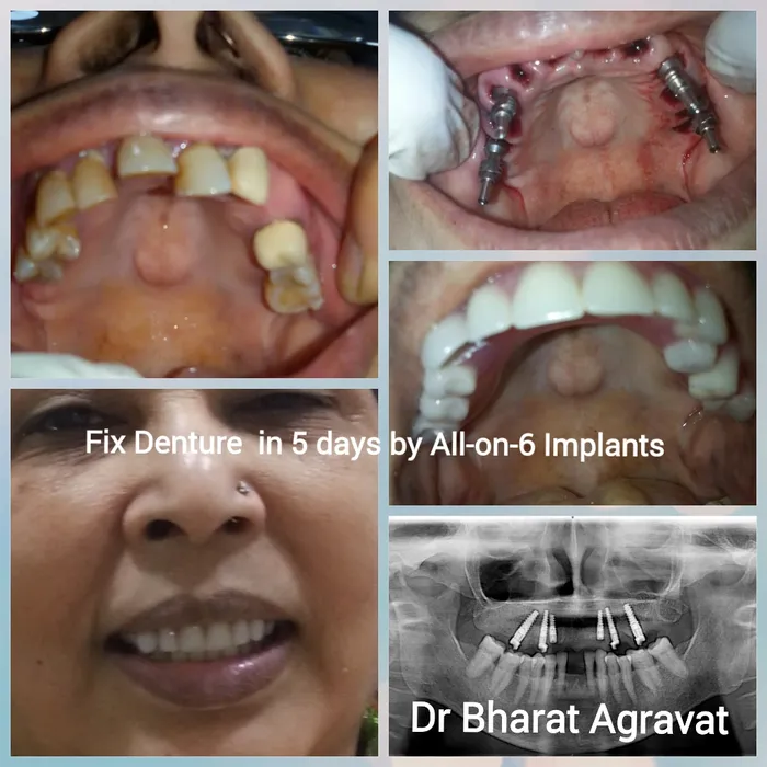 Fixed denture on All-on-6 implants, before and after