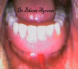 Denture locked onto the implants