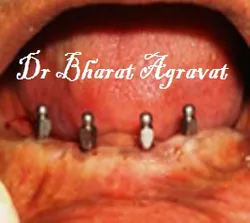 Implants placed in the lower jaw