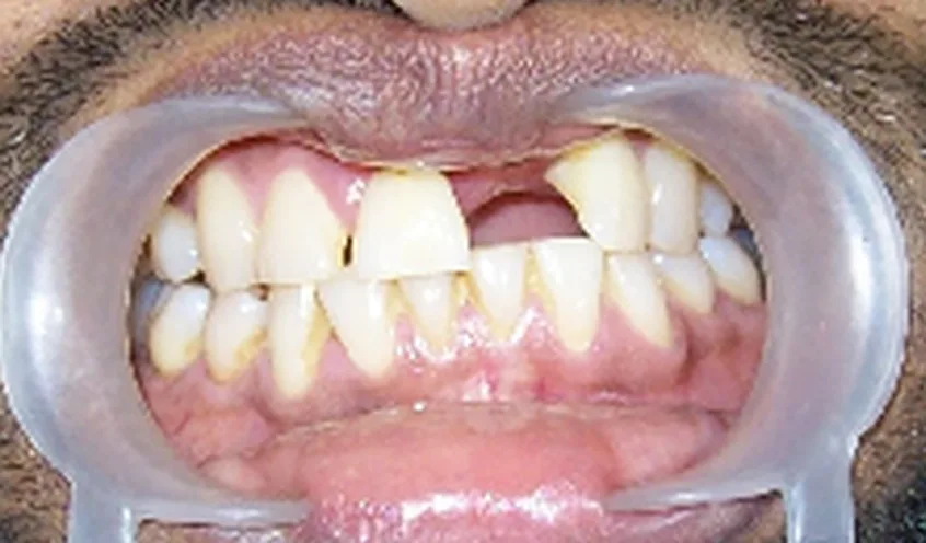 Before: missing upper front tooth