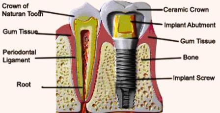 dental implants procedure video