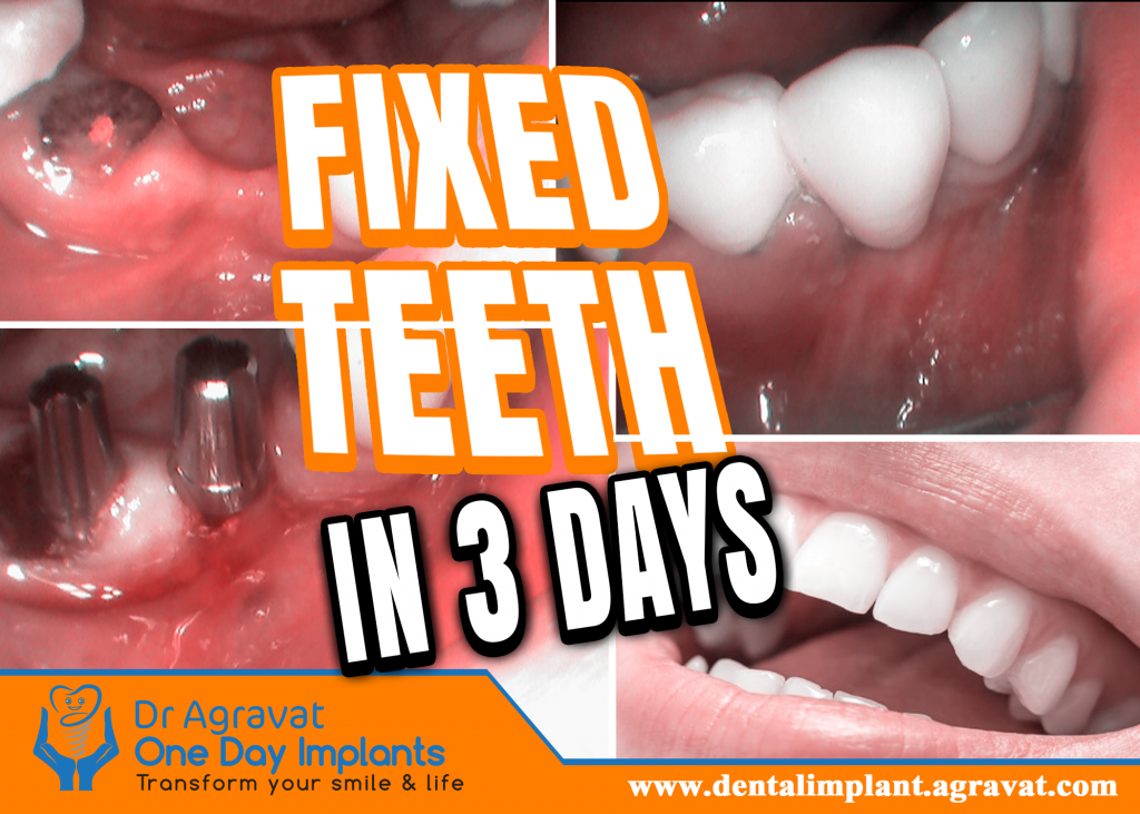 Fixed teeth in 3 days with Basal dental implants Ahmedabad, Gujarat, India Dr Bharat Agravat