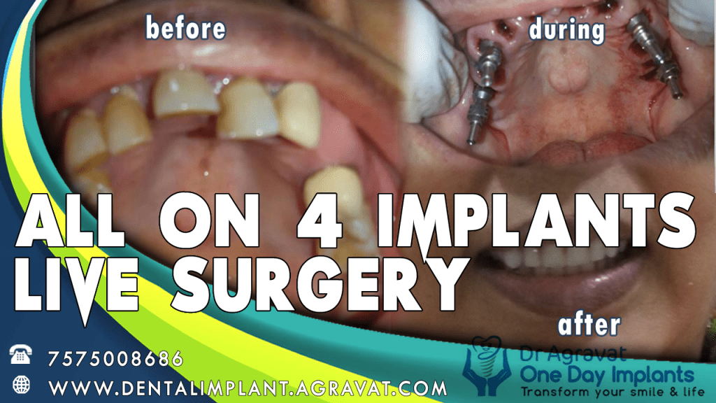 All on 4 Dental Implant Surgery Step by Step Procedure Video Ahmedabad, Gujarat, India