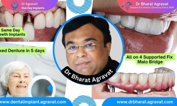 Best Dentist for Full Mouth Dental Implants Clinic in Gujarat